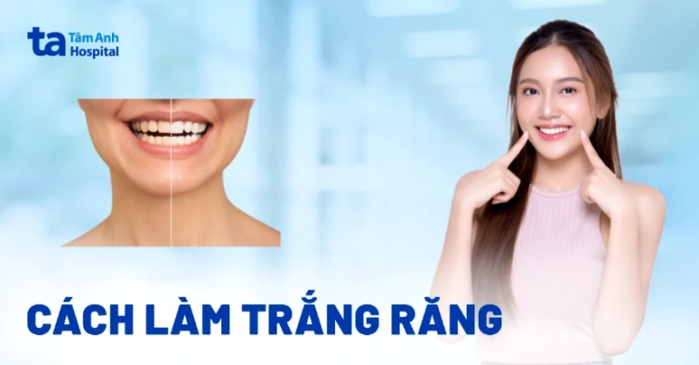 14 Cách làm trắng răng hiệu quả, an toàn và nhanh chóng tại nhà