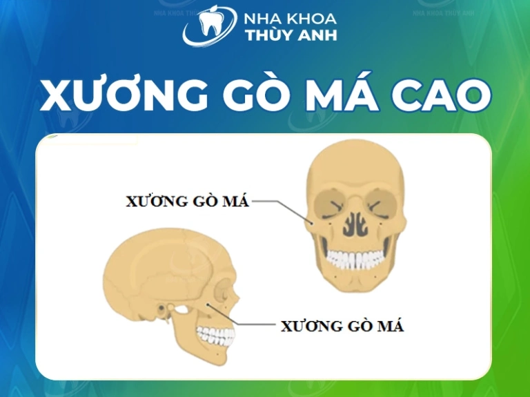 Gò Má Nhô Ra Hai Bên: Nguyên Nhân, Hậu Quả và Giải Pháp Tối Ưu Năm 2026