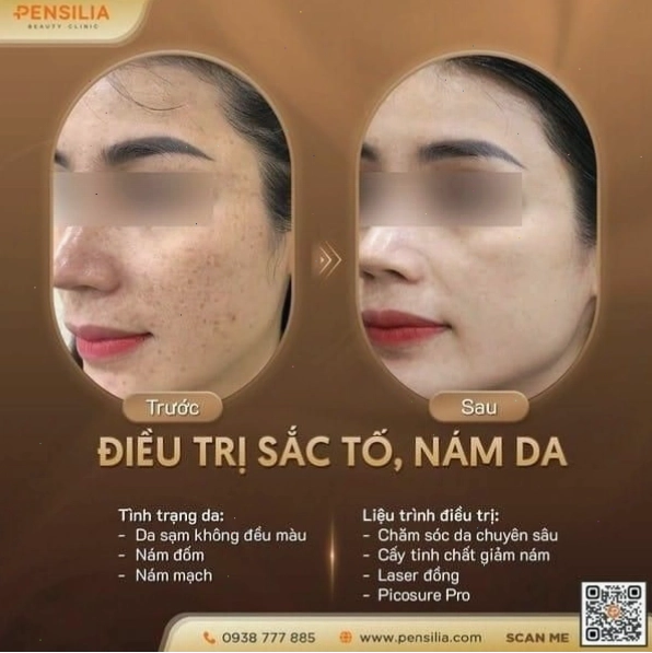 Kết quả điều trị nám da tại spa