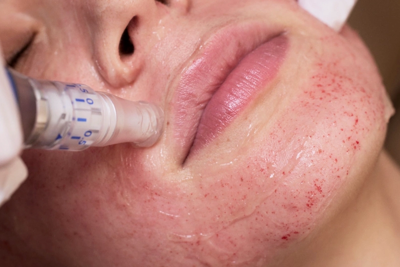 Liệu pháp Intense Pulsed Light (IPL) điều trị đốm nâu trên mặt