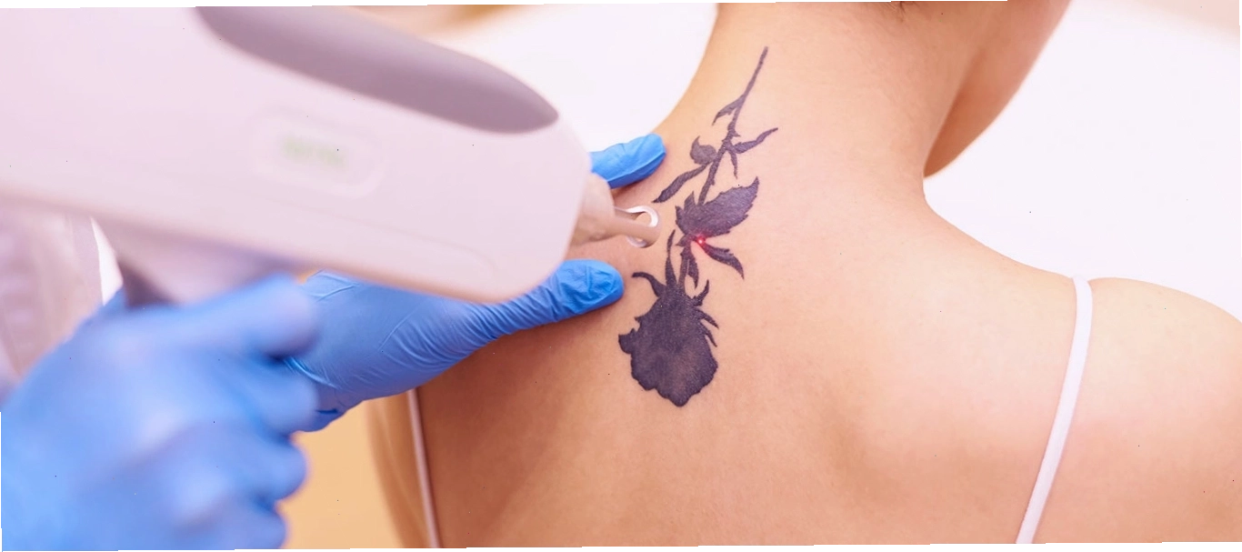Nguyên lý hoạt động của tia laser trong việc xóa hình xăm