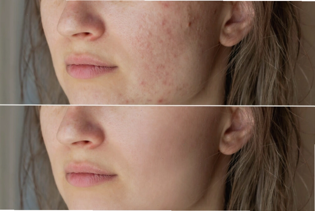 Phương pháp Chemical Peels giúp loại bỏ tế bào da chết sẫm màu