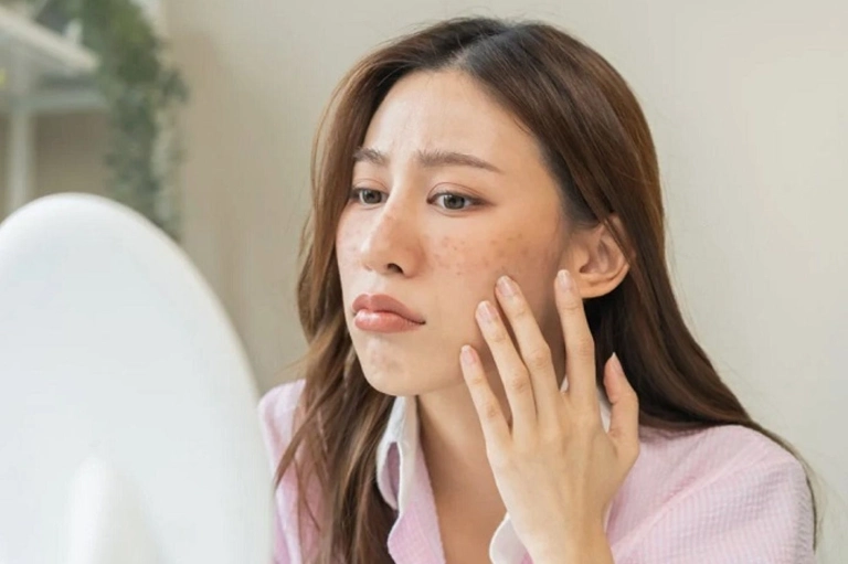 Top 10 kem trị nám tàn nhang tốt nhất hiện nay 2026: Lựa chọn chuyên gia